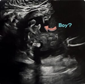 19週目、スクリーリング検査にて、男の子の可能性👶
